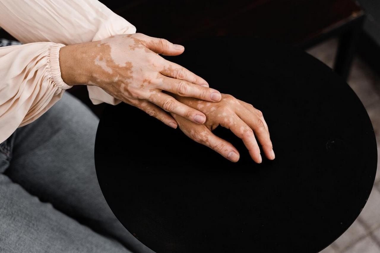 Jak wyrównać koloryt skóry dłoni